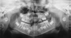 Dental Radiographs (X-Rays)