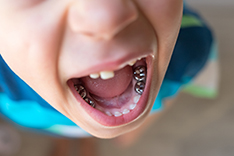 fillings